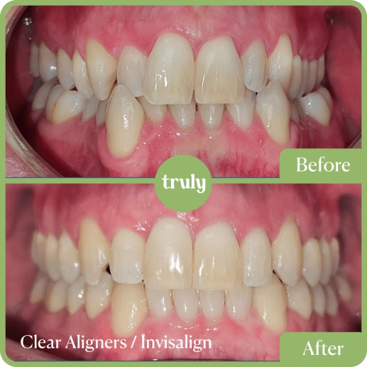 Before and after invisalign & braces at Truly, case 11