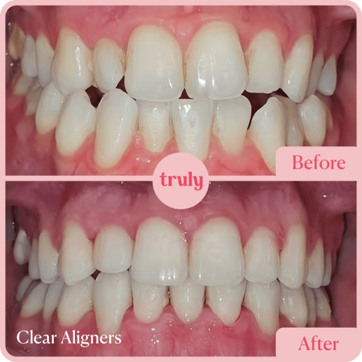 Before and after invisalign & braces at Truly, case 12