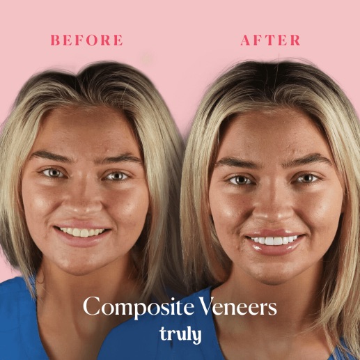 Before and after veneers & whitening at Truly, case 1