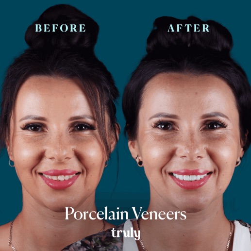 Before and after veneers & whitening at Truly, case 2