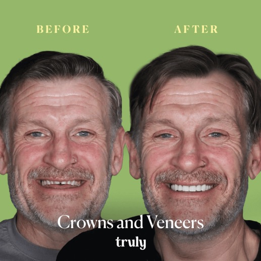 Before and after veneers & whitening at Truly, case 3