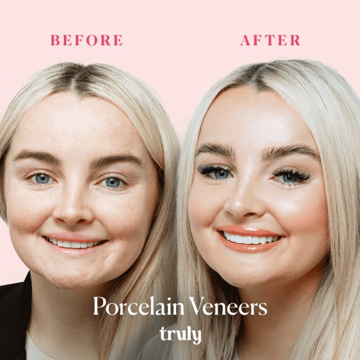 Before and after veneers & whitening at Truly, case 4