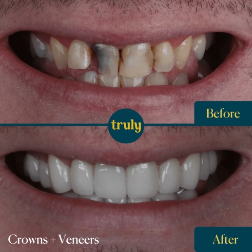 Before and after veneers & whitening at Truly, case 5