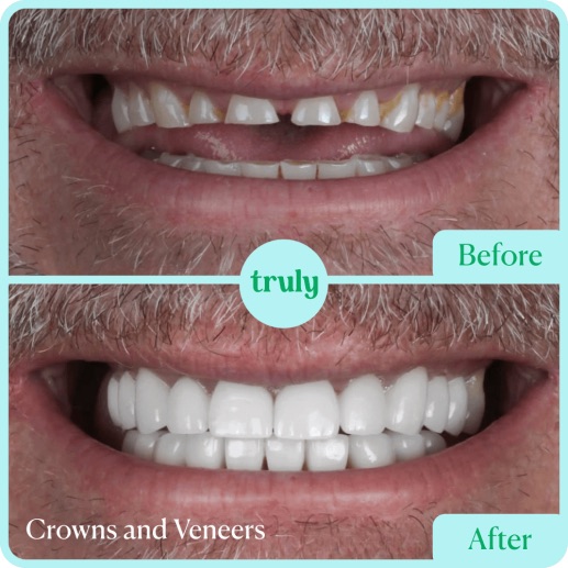 Before and after veneers & whitening at Truly, case 6