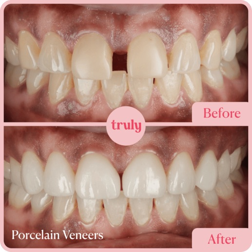 Before and after veneers & whitening at Truly, case 7