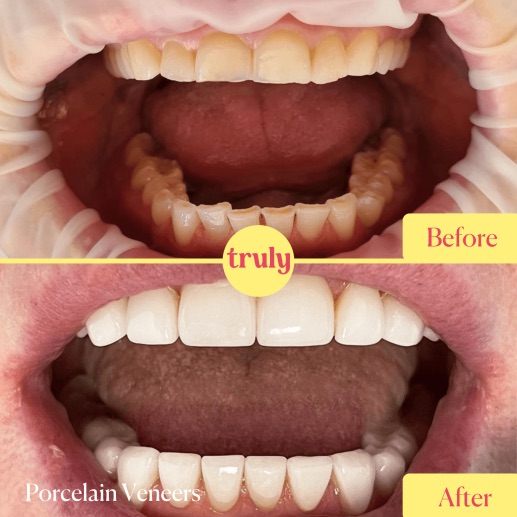 Before and after veneers & whitening at Truly, case 8