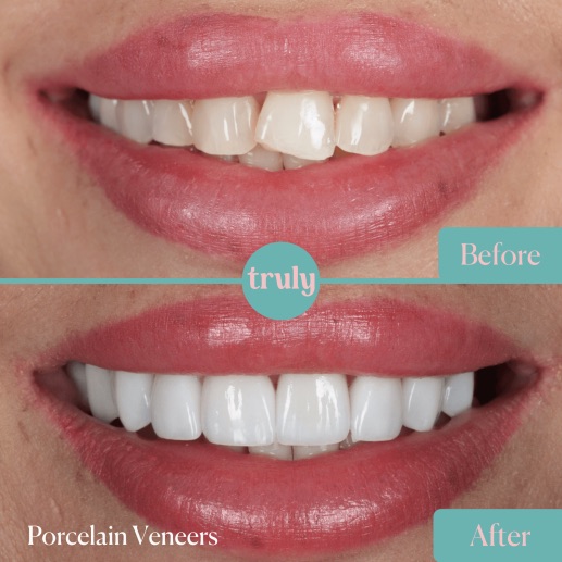 Before and after veneers & whitening at Truly, case 9