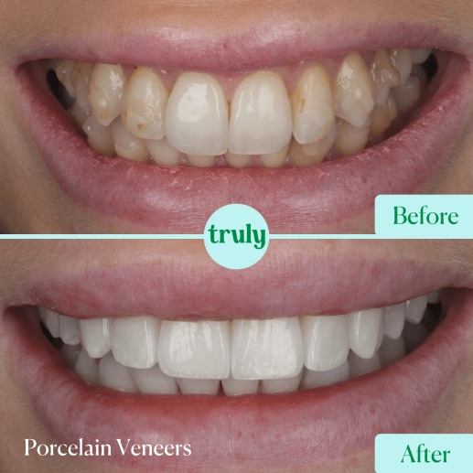 Before and after veneers & whitening at Truly, case 10