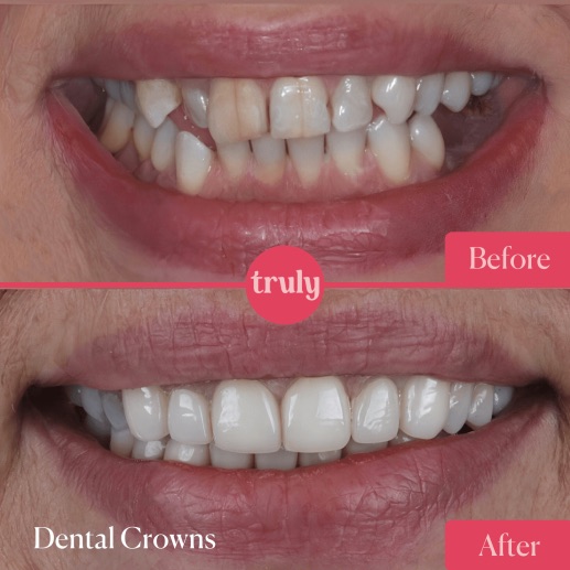 Before and after veneers & whitening at Truly, case 11