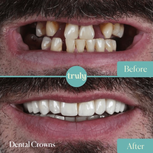Before and after veneers & whitening at Truly, case 12