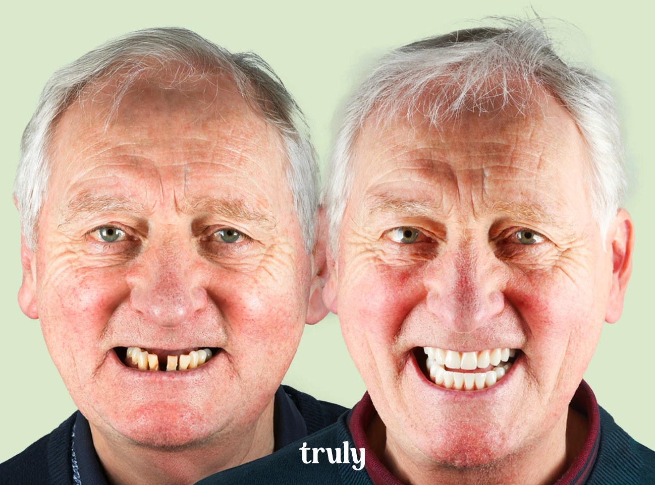 Before and after full mouth implants, Truly patient