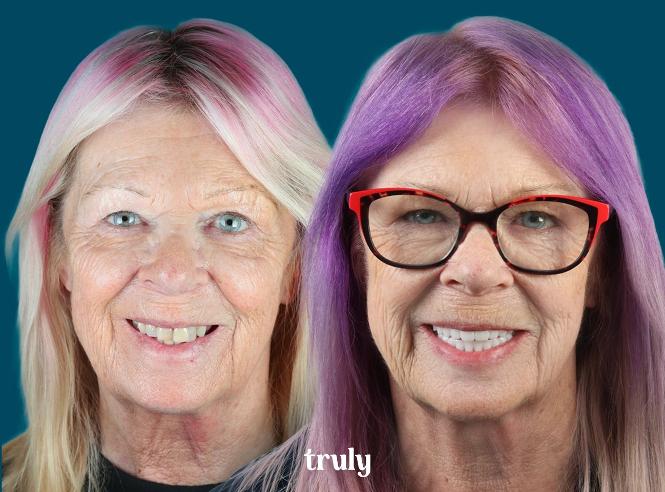 Before and after full mouth implants, Truly patient