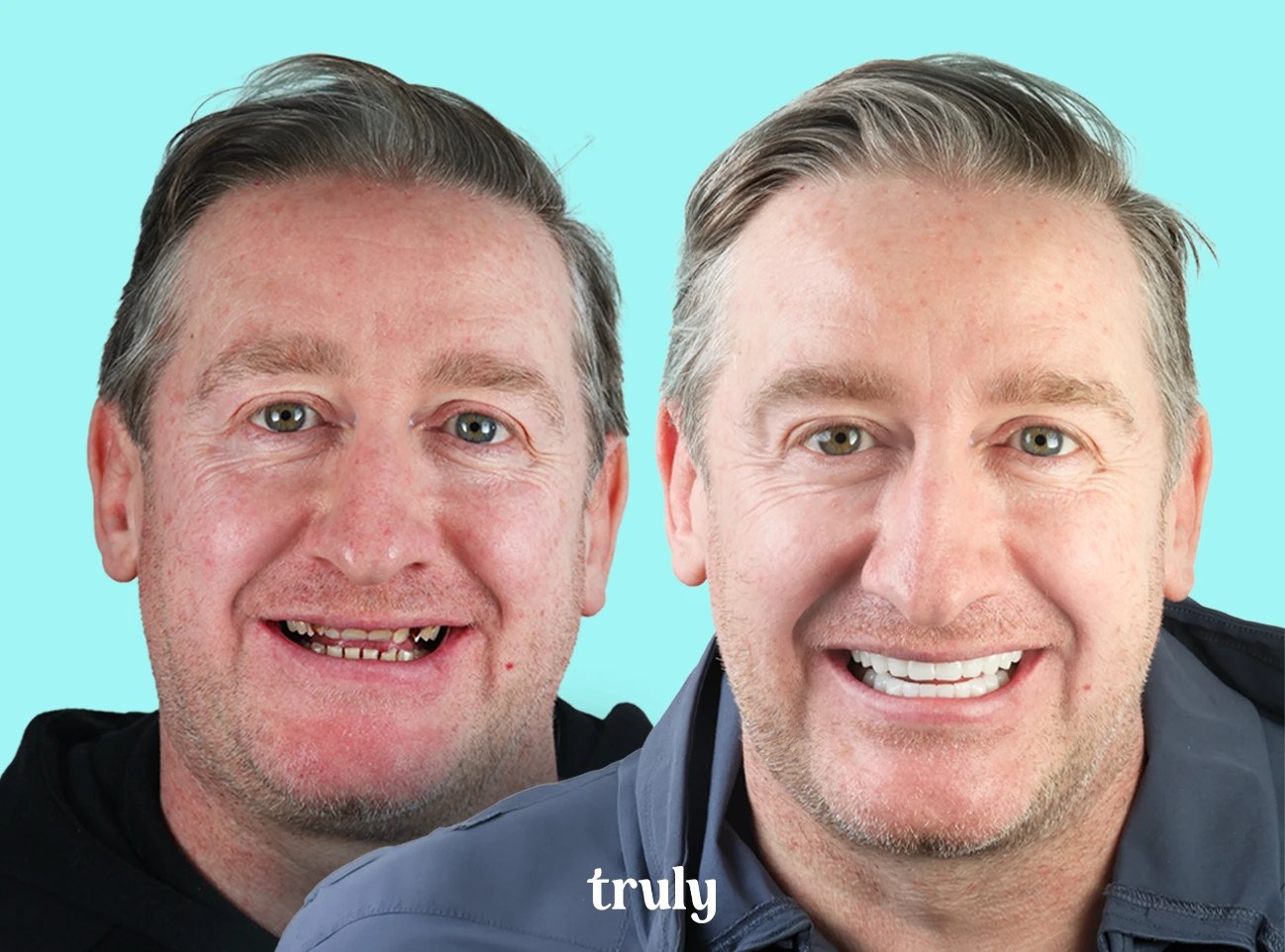 Before and after full mouth implants, Truly patient